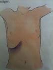 <b>Myelomonocytleukemi</b>, <b>kronisk</b> www.lookfordiagnosis.com