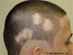 <b>Alopecia areata</b> (AA) is the