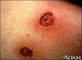 <b>Ecthyma</b> | UF Health, University of Florida Health