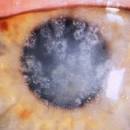 File:Granular corneal dystrophy type I. Numerous irregular shaped ...