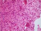 <b>Chondroblastoma</b> - PORTNotes -