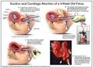 Abortion methods | ProLife NZ