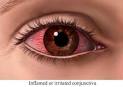 <b>keratoconjunctivitis sicca</b>