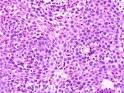 Eosinophilic Esophagitis, El Salvador Atlas of Gastrointestinal ...