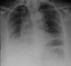 <b>mediastinal emphysema</b> and
