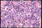 <b>Refractory Anemia</b>