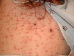 What does <b>syphilis</b> look like?