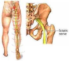 Toronto Chiropractor, Dr. Rubina Tahir treats Disc problems and Sciatica