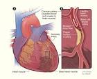 <b>Heart Disease</b>: Symptoms