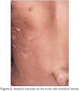 <b>Focal dermal hypoplasia</b>