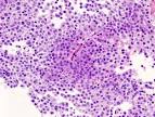 pituitary <b>adenoma</b> (1).jpg
