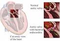Endocarditis - Health - Beliefnet.