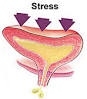 <b>Urinary incontinence</b> has seven