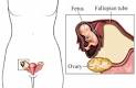 Ectopic Pregnancy: What is an Ectopic Pregnancy