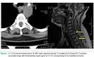 between <b>spinal subdural</b>