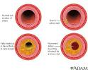 process of <b>atherosclerosis</b>