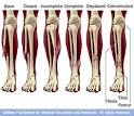 <b>closed fracture</b>,