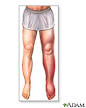 Pulmonary <b>edema</b> · Swelling