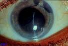 demonstrates <b>corneal edema</b>