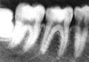 RADIOGRAFIA <b>PERIAPICAL</b>