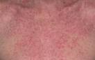 Mild <b>Eczema</b> Moderate <b>Eczema</b>