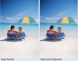 Ceratocone, ectasia, ectasia corneal, ectasia corneana, tratamento para ceratocone, cura para ceratocone, ceratocone avançado, ceratocone inicial, suspeita de ceratocone, lente para ceratocone, especialista em ceratocone, especialista ceratocone porto alegre, clinica especializada em ceratocone, oftalmologista ceratocone, oftalmologista para ceratocone, especializado em ceratocone, cone, córnea fina, cornea fina, córnea em forma de cone, cornea em forma de cone, ceratocone tratamento, ceratocone cirurgia, crosslink, cross link, crosslinking, cross linking, anel de ferrara, transplante de córnea, transplante de cornea