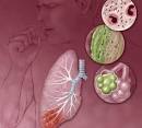 <b>pneumonia</b>