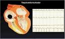 La <b>taquicardia</b> auricular tiene