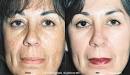 Blue Peel from Obagi, Washington, Plastic Surgery, Steven Blair Hopping, MD, ... - blue_peel1