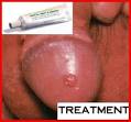Genital Warts Treatment | Genital Herpes | HPV | Cold Sore Treatments