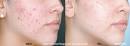 PhotoDynamic Therapy, Marina Del Rey, Facial Plastic Surgery, Farhad Sigari