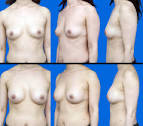 Breast Augmentation Manhattan | Breast Augmentation Before &amp; After ...