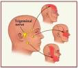 Trigeminal <b>neuralgia</b>
