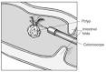 What I need to know about Colon Polyps - National Digestive ...