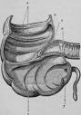 The Large Intestine Or Large Bowel (Intestinum Crassum)