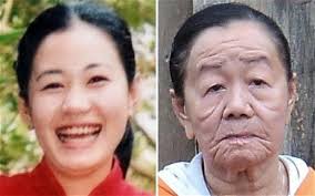 (L-R) Nguyen Thi Phuong, aged 21 and how she looks now, aged 26, after having suffered an allergic reaction to seafood Photo: HOTSPOT MEDIA - nguyenThi_2026486c