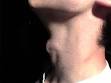 Adam's apple - Wikipedia, the free encyclopedia