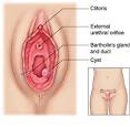 Bartholins Gland Cyst - Medical Disability Guidelines