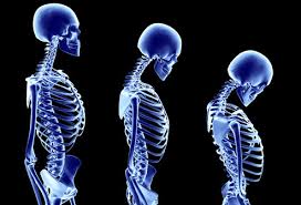 Osteoporosis