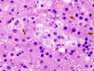 File:<b>Hepatocellular carcinoma</b>