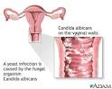  Yeast infections: Medline Plus Medical Encyclopedia Image