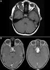 Head and neck: <b>Optic Nerve</b>