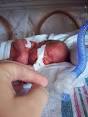 Intubated <b>preterm baby</b> in an