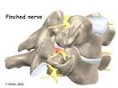 cervical <b>radiculopathy</b> are