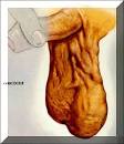 <b>Varicocele</b>