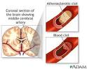 Brain Hemorrhage » stroke, Brain Hemorrhage Causes, Brain ...
