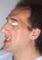 What does <b>Prognathism</b> look