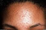 pityrosporum-<b>folliculitis</b>-