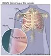 What Is Pleurisy? Causes, Symptoms, and Treatments
