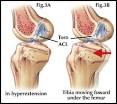 Anterior Cruciate Ligament Injuries